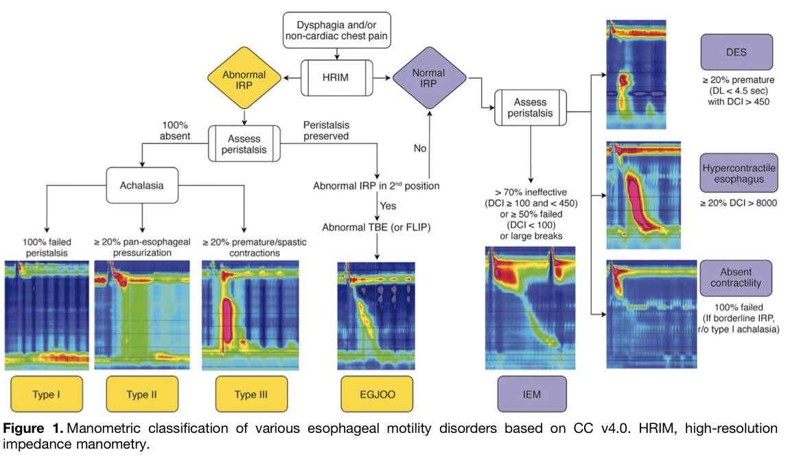 Carl Kay, MD (@carlkaymd) on Twitter photo Manometric Classification of Various Esophageal Motility Disorders
▪️Achalasia I, II, & III
▪️EGJOO
▪️DES
▪️Hypercontractile esophagus
▪️Absent contractility
▪️IEM
Sx ➡️ HRM ➡️ IRP ➡️ DCI ➡️ Dx
Best resource for 🆕 fellows 👇
🔗 gastrojournal.org/action/showPdf…
🙏<a href="/EsophagusDoc/">Dan Patel, MD</a> Manometric Classification of Various Esophageal Motility Disorders
▪️Achalasia I, II, & III
▪️EGJOO
▪️DES
▪️Hypercontractile esophagus
▪️Absent contractility
▪️IEM
Sx ➡️ HRM ➡️ IRP ➡️ DCI ➡️ Dx
Best resource for 🆕 fellows 👇
🔗 gastrojournal.org/action/showPdf…
🙏<a href="/EsophagusDoc/">Dan Patel, MD</a>
