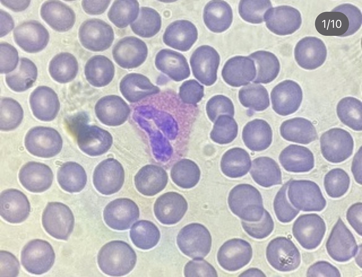 dimorphicfungi's tweet photo. Woke up this morning with my allergies on a thousand 🤧🙄 This is my eosinophil (picture taken 2 weeks ago)  with whom I have a love/hate relationship. 

#microscopelife #rbcs #wbcs #lab #eosinophils #allergyseason https://t.co/QjQc9hFct0