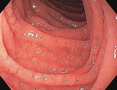 Patient with tiredness, bloating and anaemia. This is the view of the duodenum. What’s the diagnosis?