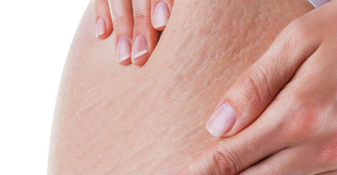 #Cellfina for cellulite can make you look and feel years younger. bit.ly/3vo9bO6