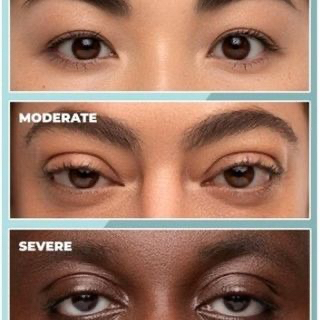 Vision Optique (@visionoptique) on Twitter photo #TechTuesday:
Repost from <a href="/upneeq/">Upneeq.SSMD</a> - What do low-lying lids look like? You may have acquired ptosis if your eyelids resemble any of these images. Don't wait! Ask about treatment options like Upneeq® 0.1% for low-lying lids in adults. #TechTuesday:
Repost from <a href="/upneeq/">Upneeq.SSMD</a> - What do low-lying lids look like? You may have acquired ptosis if your eyelids resemble any of these images. Don't wait! Ask about treatment options like Upneeq® 0.1% for low-lying lids in adults.