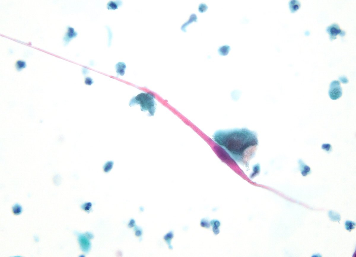 sza_jhcyto's tweet image. “Tadpoles and Fibers” - Squamous Cell Carcinoma of the Urinary Bladder in voided urine.