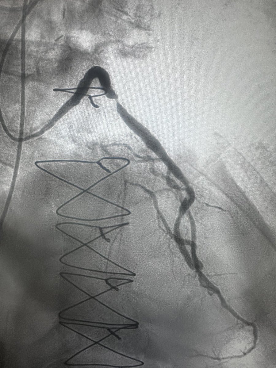 nonewusername1's tweet photo. Challenging NSTEMI with a complex multi strand vein graft. The challenge was to get enough support to ensure safe percutaneous intervention. 
#guideliner 
#highriskpci https://t.co/GfCwjF2iiR