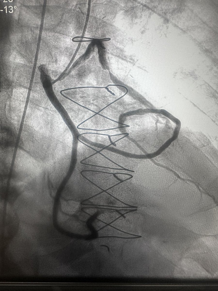 nonewusername1's tweet photo. Challenging NSTEMI with a complex multi strand vein graft. The challenge was to get enough support to ensure safe percutaneous intervention. 
#guideliner 
#highriskpci https://t.co/GfCwjF2iiR