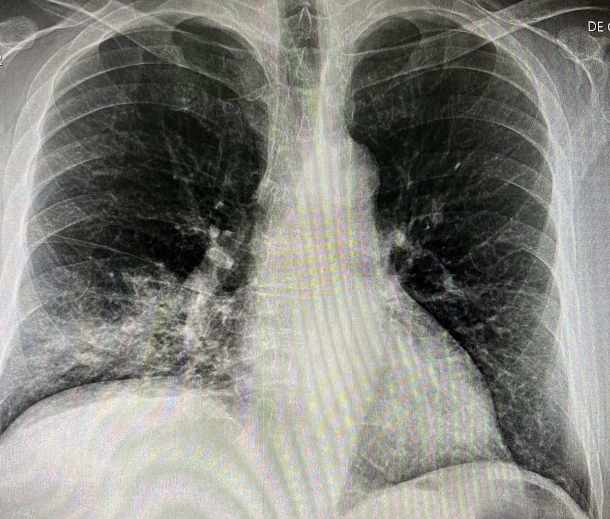 Just successfully treated a COVId-19 positive patient with pneumonia and pulse ox 84% on room air because he refused to be admitted and treated with Remdesivir. He knew it was liver toxic and has had a liver transplant. The admitting doctor wanted to give it anyway. He is now…