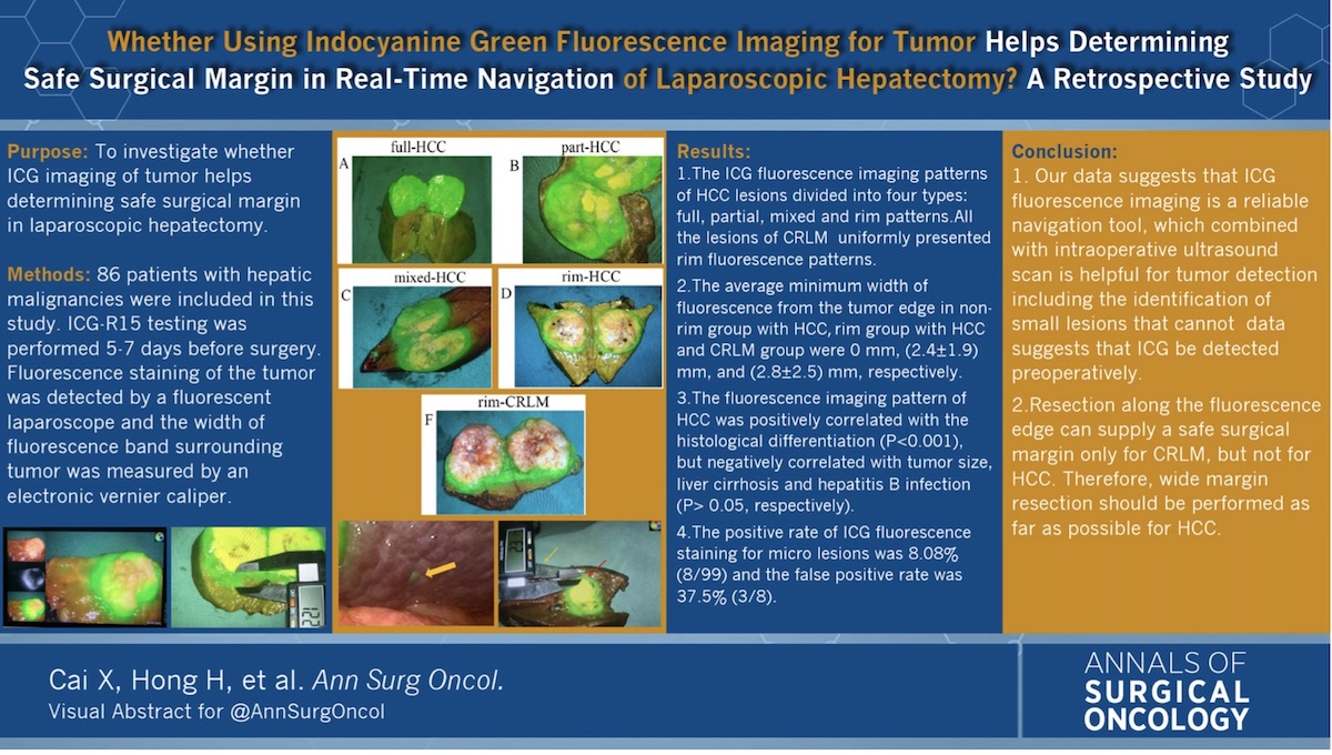 Does Using #IndocyanineGreen Fluorescence Imaging for Tumors Help in Determining the Safe Surgical Margin in Real-Time Navigation of #Laparoscopic #Hepatectomy ? A Retrospective Study rdcu.be/c6kCN #VisualAbstract @McMastersKelly
