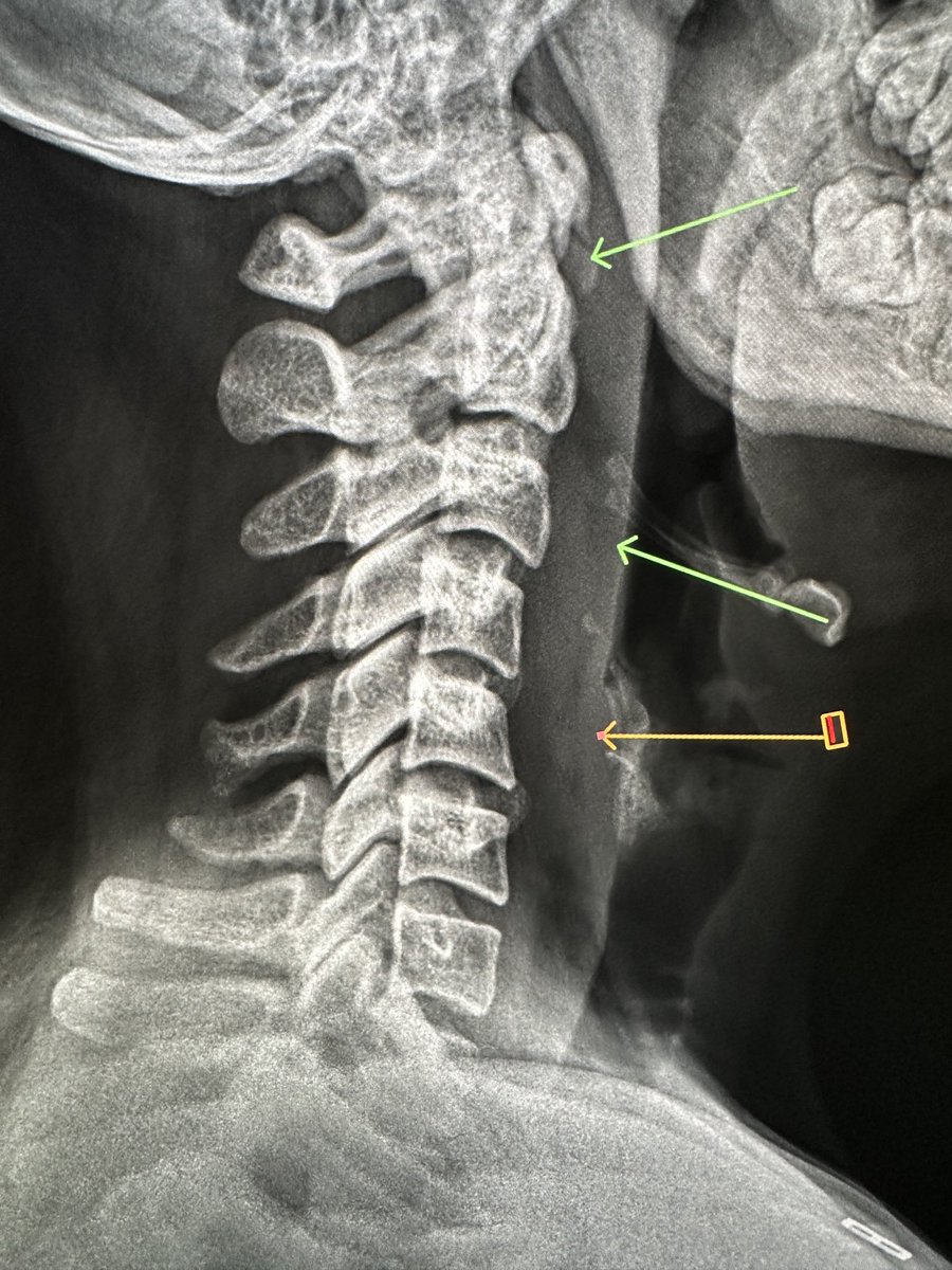 northwoods1980's tweet image. An absolute modern day miracle. This calcific tendinitis diagnosed by x-ray and clinical exam but MOST impressively, to my delight, treated appropriately/conservatively completely recovered without MRI or CT! ✅