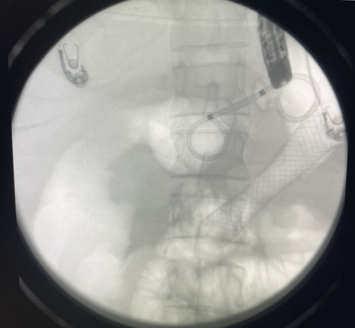😱😱😱😱😱 Endoscopic gastroduodenostomy in patient with prior Bilroth II now with obstructing gastric mass resulting in closed loop obstruction of the afferent loop. Well done @MuzaffarAkbar 👏🏽 @ASGEendoscopy #GITwitter @UpstateGastro