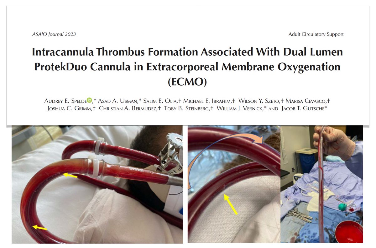 ELSO (@elsoorg) on Twitter photo Intracannula thrombosis in #COVID19 associated respiratory failure on oxy-RVAD. Case series detailing thrombus formation within dual lumen RA to PA #ECMO cannula. In all pts thrombus developed in the setting of additional venous cannula.
<a href="/asaiojournal/">asaiojournal</a>
🖇️ bit.ly/3IVGIr2 Intracannula thrombosis in #COVID19 associated respiratory failure on oxy-RVAD. Case series detailing thrombus formation within dual lumen RA to PA #ECMO cannula. In all pts thrombus developed in the setting of additional venous cannula.
<a href="/asaiojournal/">asaiojournal</a>
🖇️ bit.ly/3IVGIr2