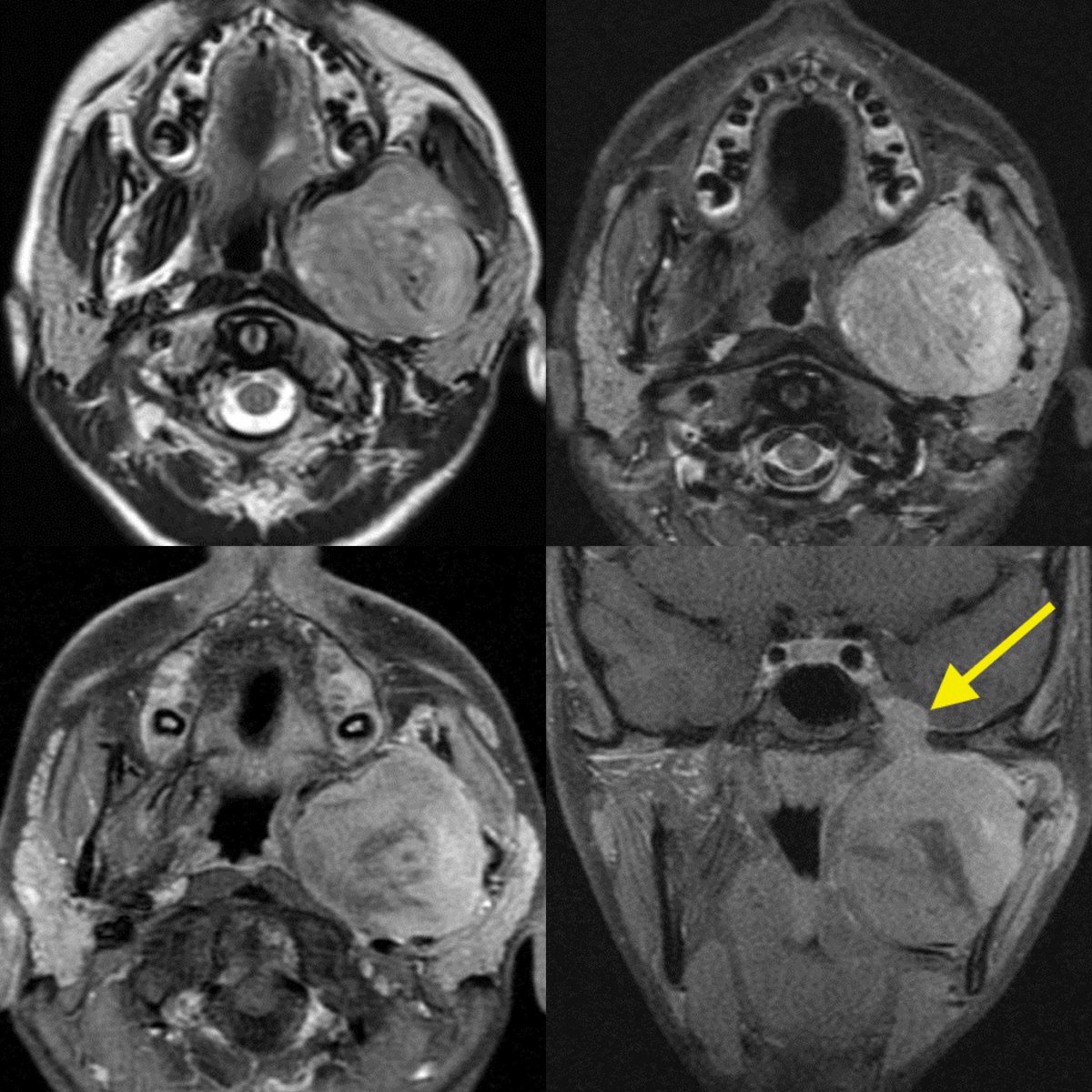 Confirmed case of a rhabdomyosarcoma of the masticator space Head and neck locations: orbit, nasal cavity, neck/face Rhabdomyosarcomas are the most common tumors of the masticator space in children #ent #peds #Neurosurgery #radres @ASHNRSociety @The_ASPNR #medtwitter