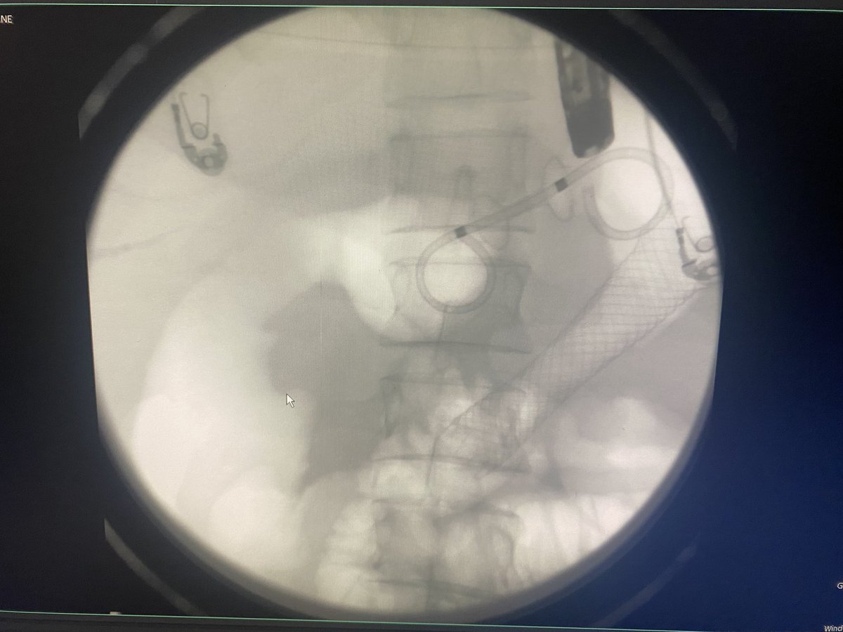 Case of the week @SUNY Upstate EUS guided Gastroenterostomy in patient with Closed Loop Duodenal Obstruction from Gastric AdenoCA at GJ anastomosis with Previous Bilroth II Surgery.