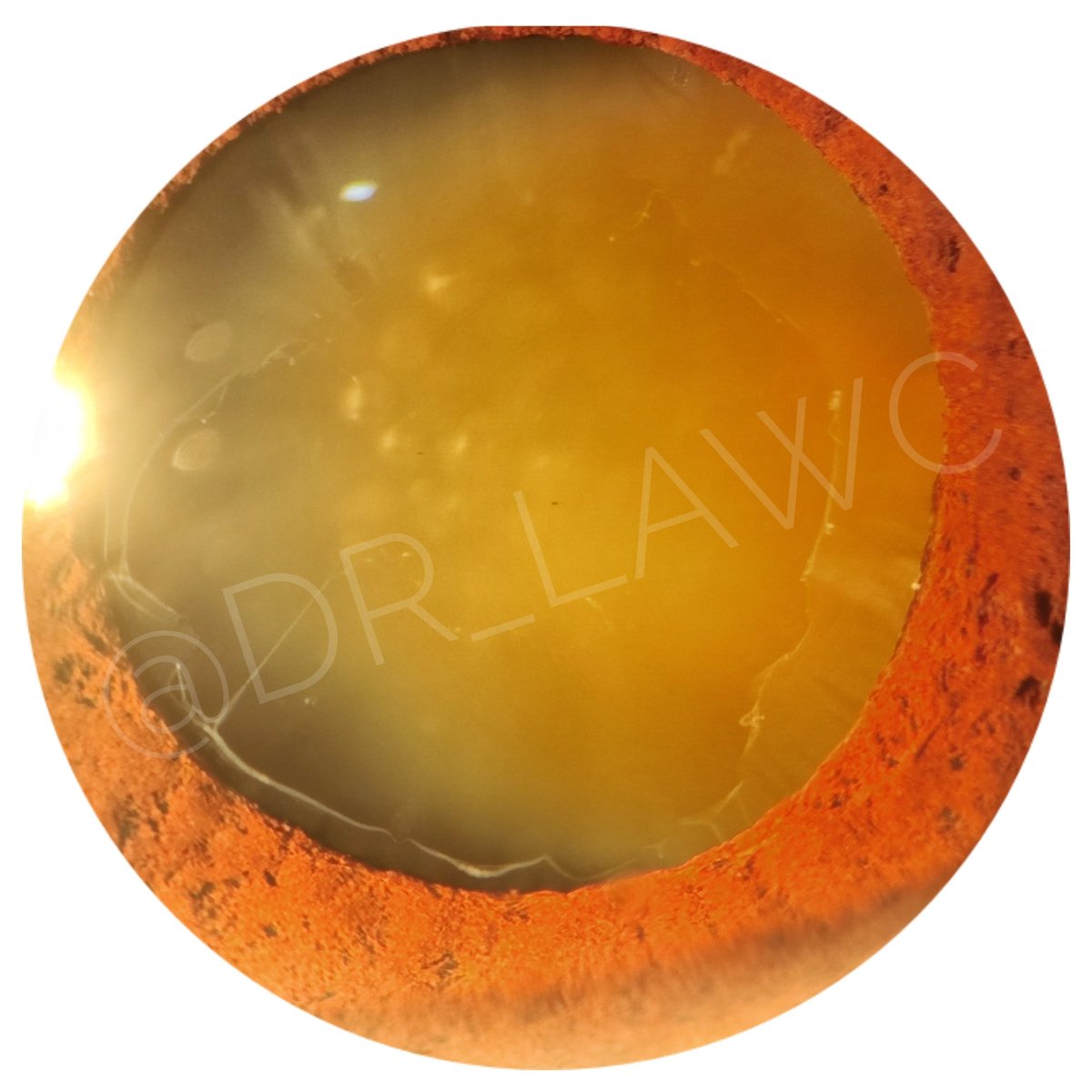 Dr_LawC's tweet photo. Hoy les traigo este caso que llegó a mi consulta. Acudió por disminución de agudeza visual ambos ojos, progresiva e indolora. Al dilatar las pupilas vi ésto. (observen ese anillo y el material blanquecino que recubre el cristalino) https://t.co/btUCZsdgMn