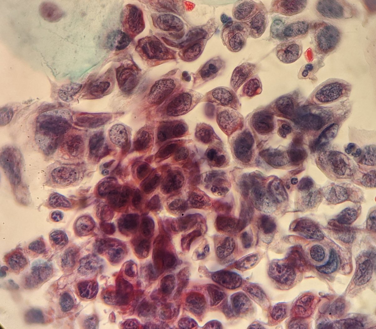PSzwebel's tweet photo. Nice cytohistologyc correlation.
Convencional Pap Smear with HSIL/ CIN 3
Cervical biopy whit HSIL/CIN3 https://t.co/qtOTvwVas5