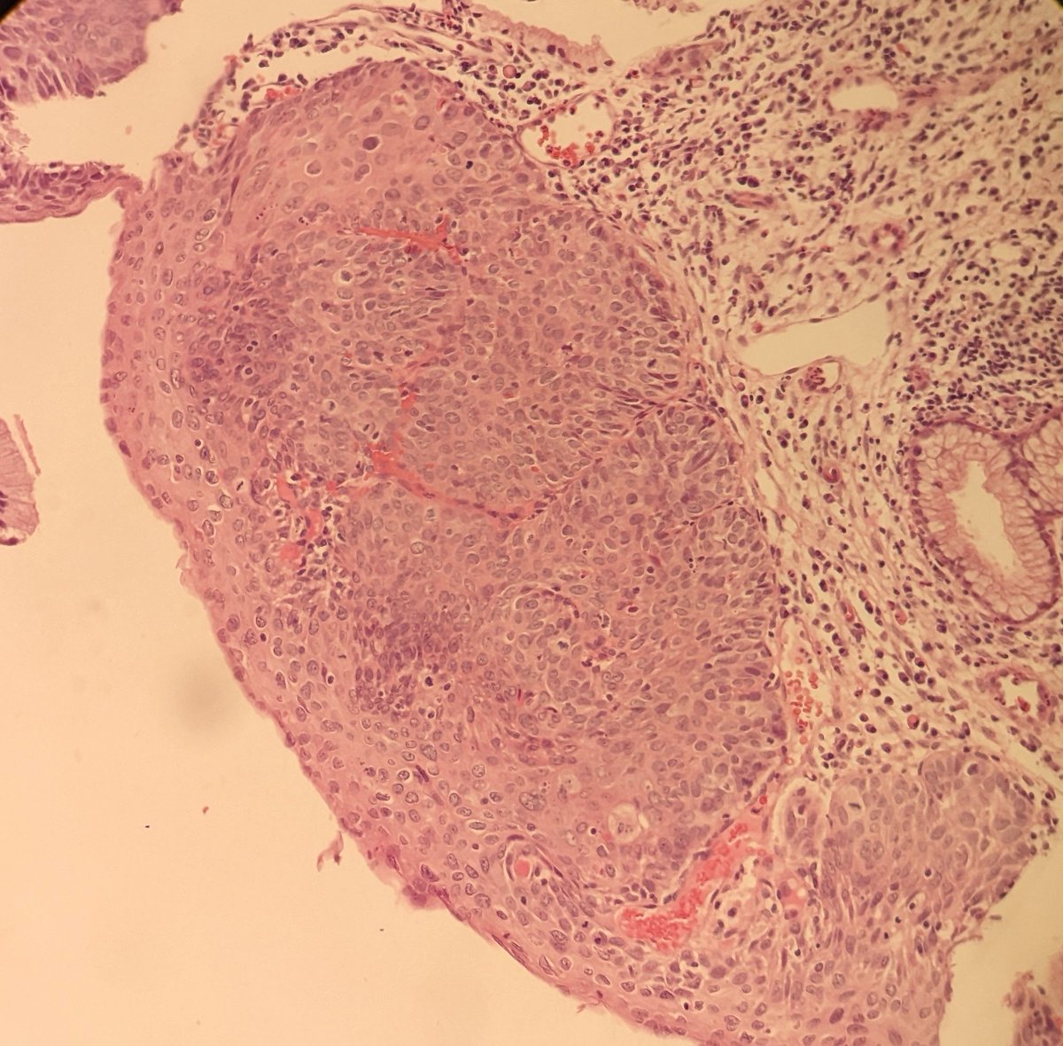 PSzwebel's tweet photo. Cervical biopy https://t.co/JvsYsNe4IP