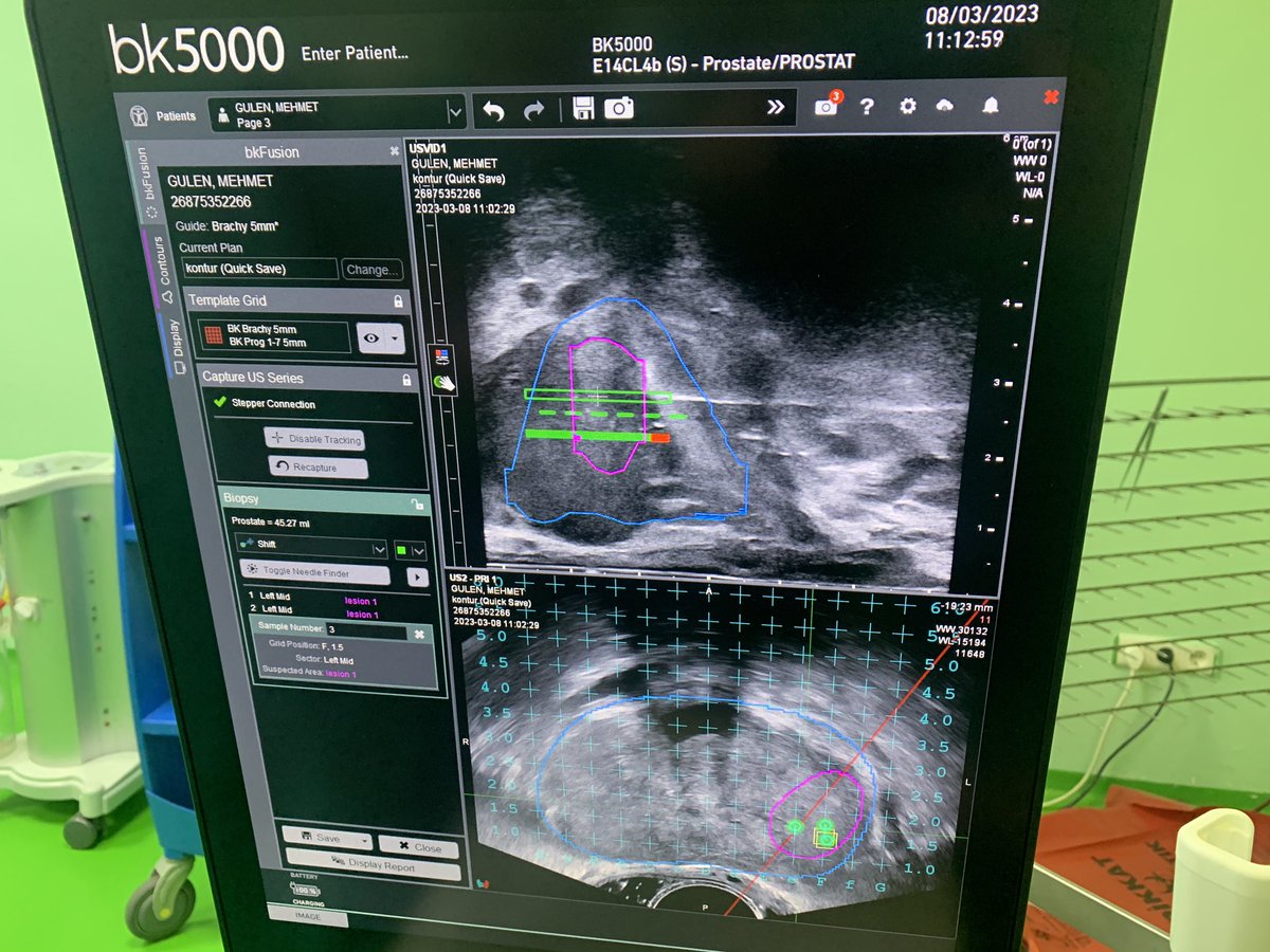 Urology resident in action. Perineal prostate fusion biopsy with @BKfusion <a href="/gurcanmehmet61/">Mehmet Gürcan MD</a> <a href="/bk_Medical/">bk Medical</a> <a href="/itfuroloncology/">İTF Üroloji A.D. Ürolojik Onkoloji Bilim Dalı</a> <a href="/maarrabal/">Miguel Angel Arrabal</a> @yolandaRodVaz
