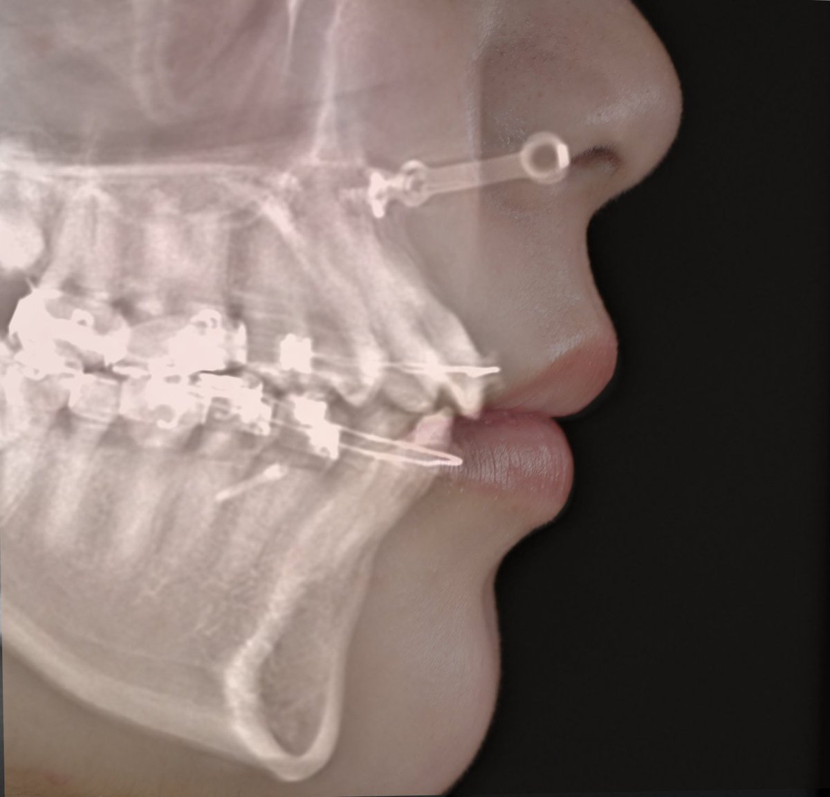 dds_cozy's tweet image. 「そして８ヶ月検診」
・鼻柱基部を前方へ（猫手術のように）
・鼻翼基部は人工真皮でボリュームを（貴族手術のように）