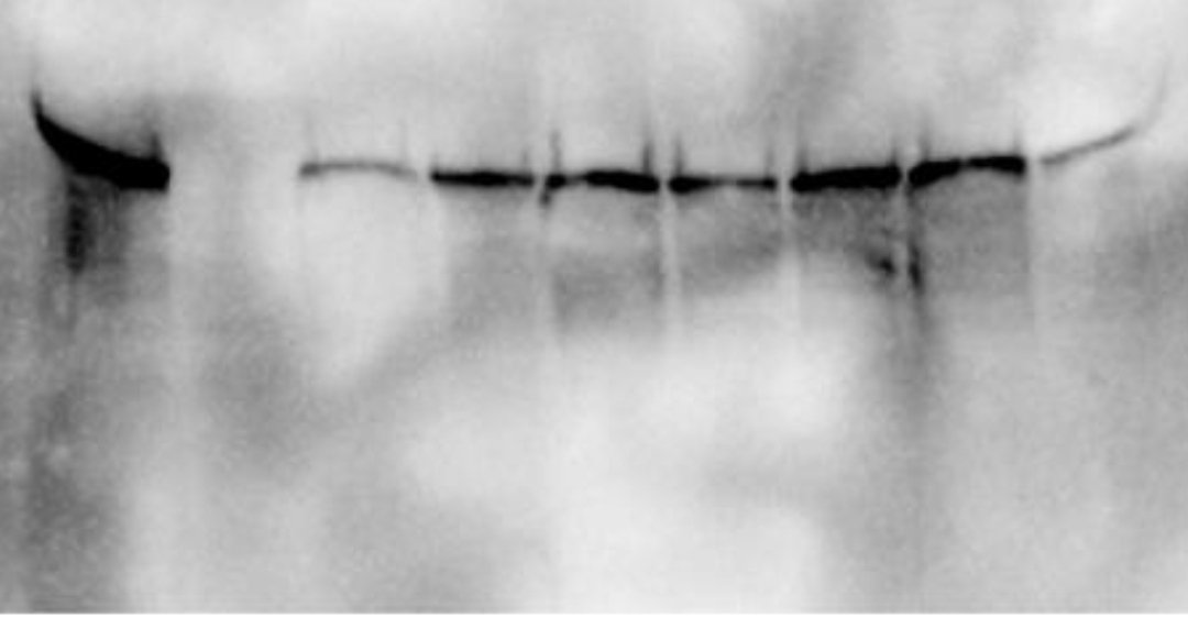 Work by Jayshen, PhD student in our lab who treated patient cells with CRISPR gene editing and successfully restore the protein expression. Kudos Jay. Can't wait to get this published. NB: the one without band is the untreated patient cells.