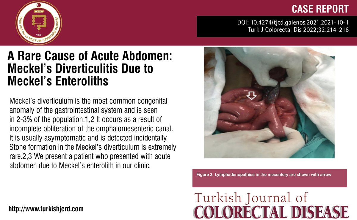 turkdiscolrect's tweet photo. A Rare Cause of Acute Abdomen: Meckel’s Diverticulitis Due to Meckel’s Enteroliths
You can see the free full text of the research by Mervan Savda et al.
Link : https://t.co/T6Lw4RpwCK
#Diverticulitis #enterolith #meckel #diverticulum https://t.co/HXNaZST7Mx
