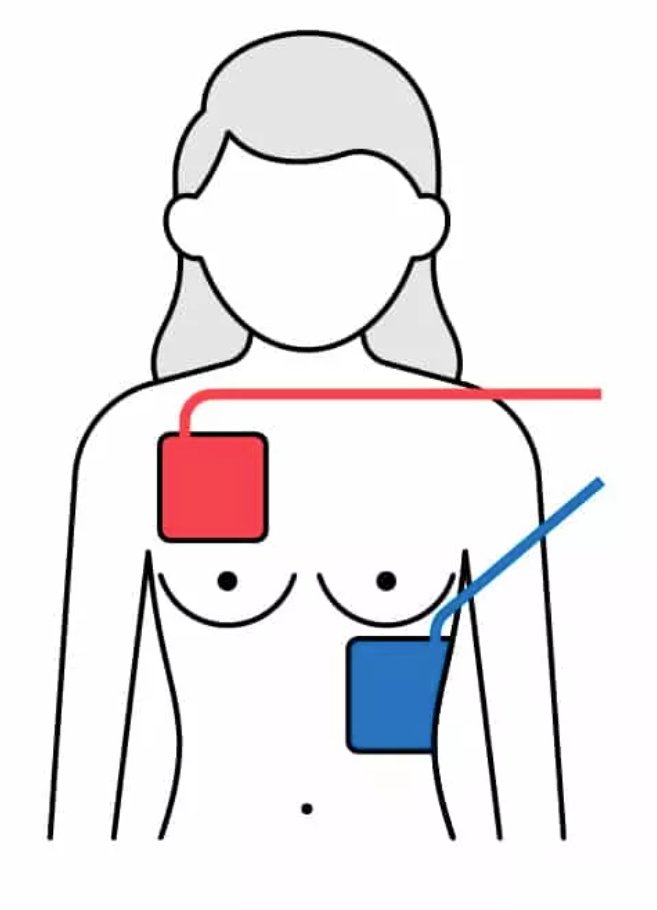 Happy International Women's Day💃🏼👭 

The perfect day to talk about - Bra off, Defib on - a simple phrase with life-saving consequences!

(A thread)

#InternationalWomensDay2023 #InternationalWomansDay