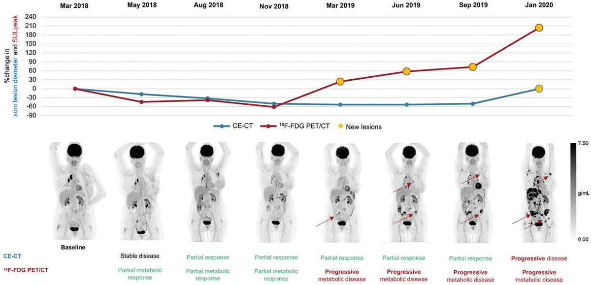 JournalofNucMed's tweet photo. PET is superior: ¹⁸F-FDG PET/CT detects metastatic #BreastCancer progression earlier than CE-CT in most patients, with a potentially clinically relevant median 6-month delay for CE-CT. https://t.co/NNGIu0vcaZ 

#NuclearMedicine #PETscan @marianne_vogsen @onko_ouh https://t.co/wwWiCAvC6X