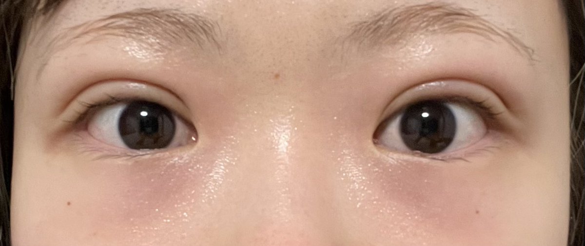 ayane_sbc's tweet photo. 3月7日(ダウンタイム5週間経過)

腫れも引いてだいぶ自然になりました！ https://t.co/xmVZiMQnsY