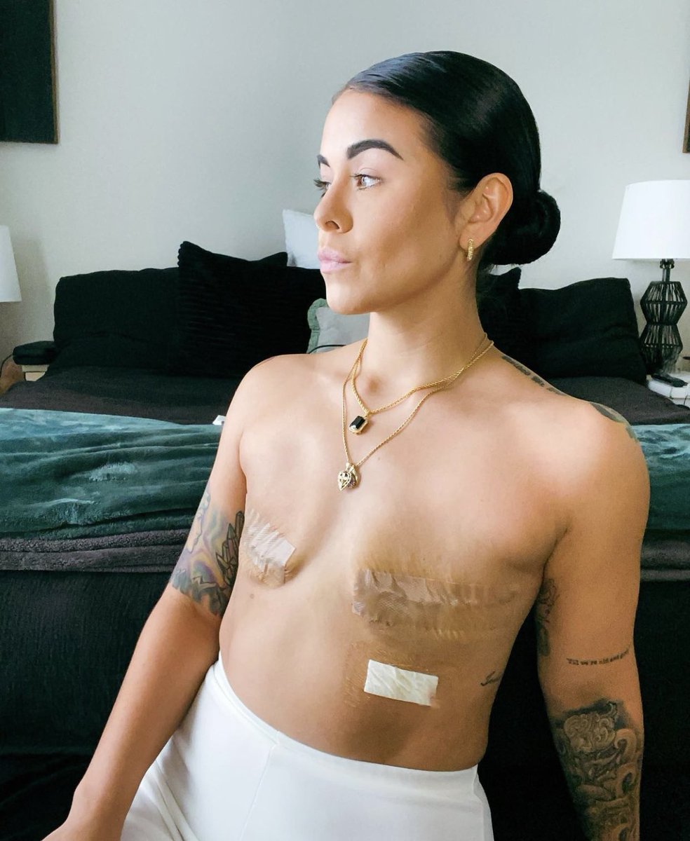 GossipRoomOff's tweet photo. 🚨 À 29 ans, alors que Stephanie est en bonne santé, elle choisit de subir une double mastectomie préventive après avoir été testée positive à la mutation du gène BRCA1. Cette mutation augmente considérablement le risque de développer un cancer du sein. La jeune femme a donc pris la décision douloureuse et radicale de se faire retirer la poitrine sans reconstruction par la suite dans le but d’éviter d’autres complications. Aujourd’hui, elle tente de normaliser ces opérations et de faire de la prévention ! Bravo à elle ! 💪👏 (via AuFeminin)

📸: theebooblessbabe
