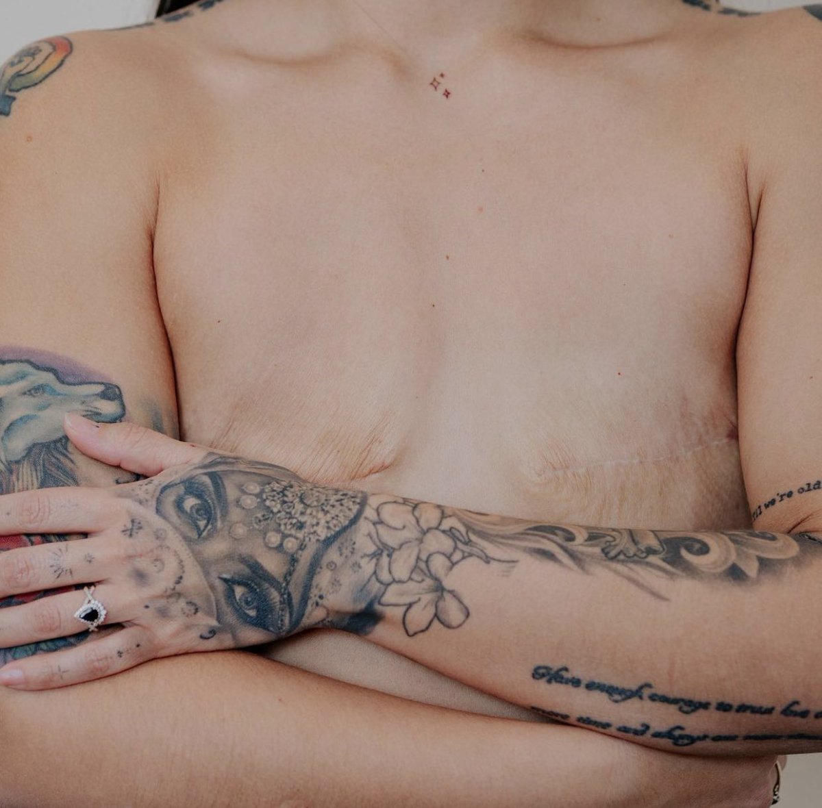 GossipRoomOff's tweet photo. 🚨 À 29 ans, alors que Stephanie est en bonne santé, elle choisit de subir une double mastectomie préventive après avoir été testée positive à la mutation du gène BRCA1. Cette mutation augmente considérablement le risque de développer un cancer du sein. La jeune femme a donc pris la décision douloureuse et radicale de se faire retirer la poitrine sans reconstruction par la suite dans le but d’éviter d’autres complications. Aujourd’hui, elle tente de normaliser ces opérations et de faire de la prévention ! Bravo à elle ! 💪👏 (via AuFeminin)

📸: theebooblessbabe