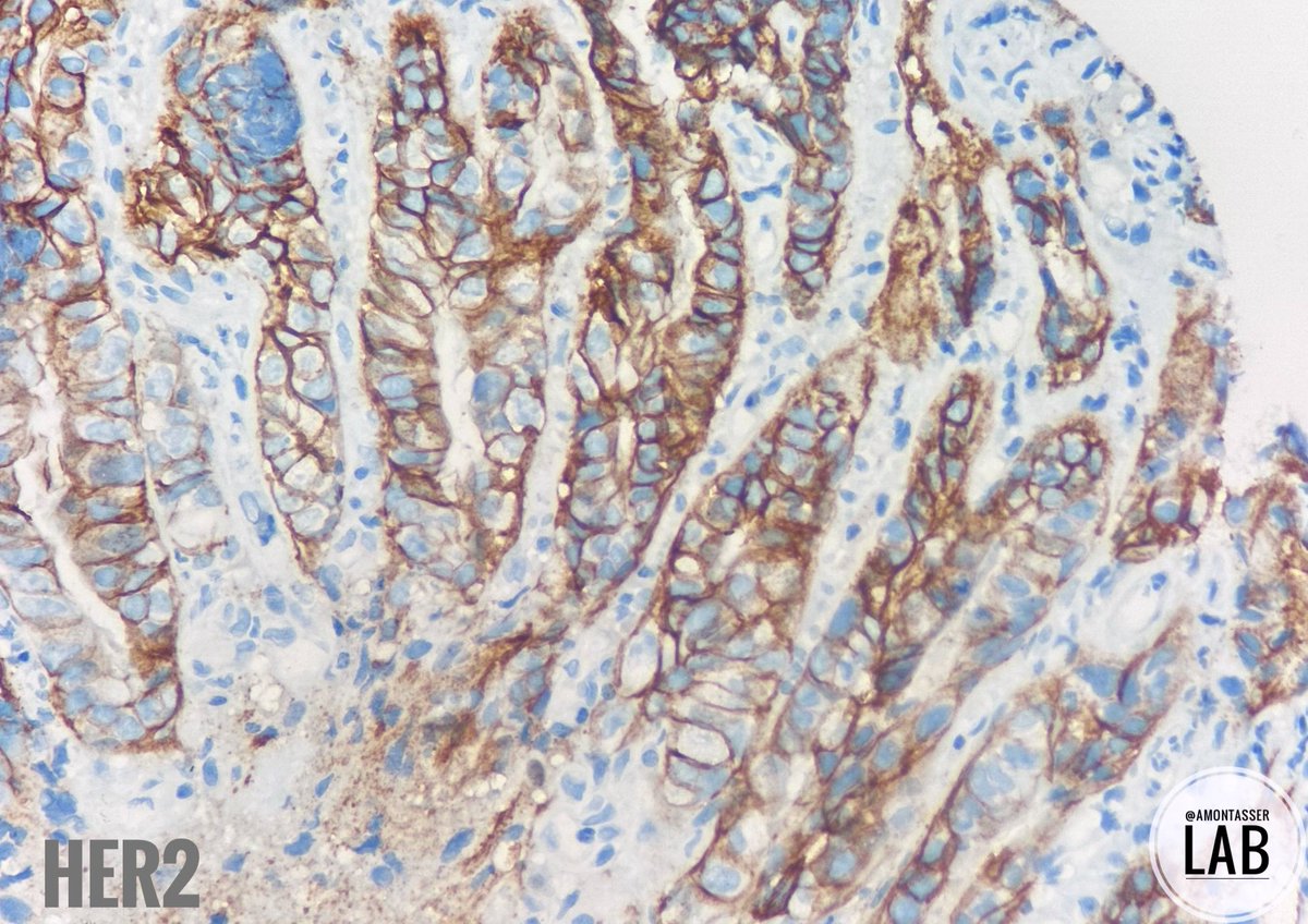 HER2-positive gastric adenocarcinoma

#Pathology #GIpath #PathTwitter