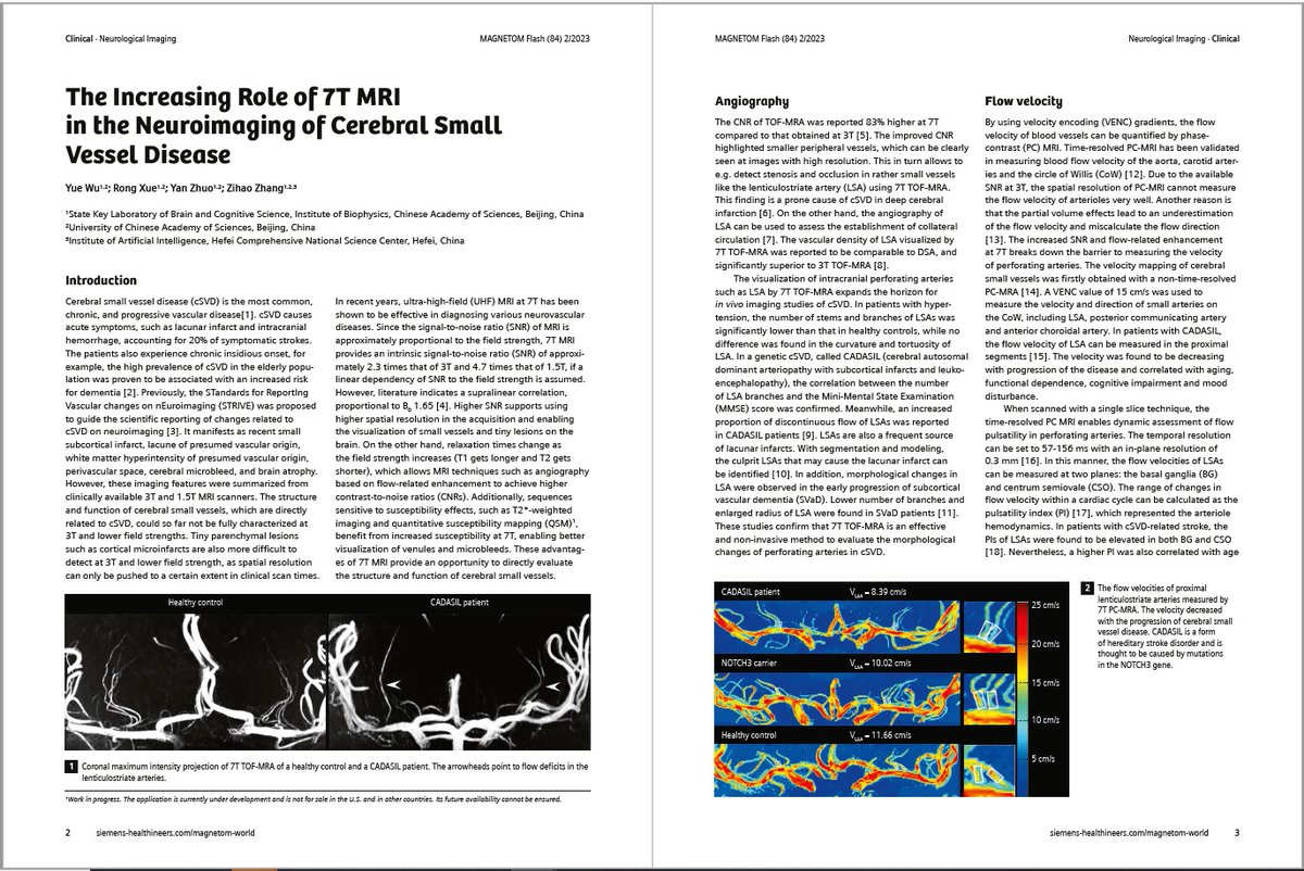 The Increasing Role of #7T #MRI in the Neuroimaging of Cerebral Small Vessel Disease (cSVD) by Dr. Zihao Zhang, et al. (Chinese Academy of Sciences, Beijing, China). Learn more at …ng.webassets.siemens-healthineers.com/b4200a953da925…
#magnetomworld #stroke #Neuroradiology #ultrahighfield