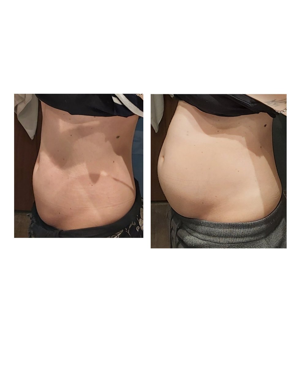 Requiem por el fallecimiento de la sanidad publica en Asturias
Primera cita con especialista digestivo 6 meses despues de la entrada en AP. Cita SUCESIVA 22 MESES DESPUES DE PRIMERA CITA.
Esta es mi situacion diaria (izquierda en ayunas, derecha lo que sucede si ingiero alimento)