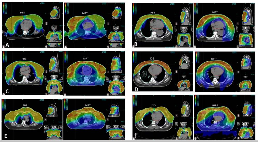theijpt's tweet image. Substantial dose reductions to multiple OAR while maintaining target coverage make #protontherapy the preferred modality for bilateral breast cancer treatment - learn more: bit.ly/IJPT-Spring-20… #CancerResearch #cancer #breastcancerawareness @UFProtonTherapy