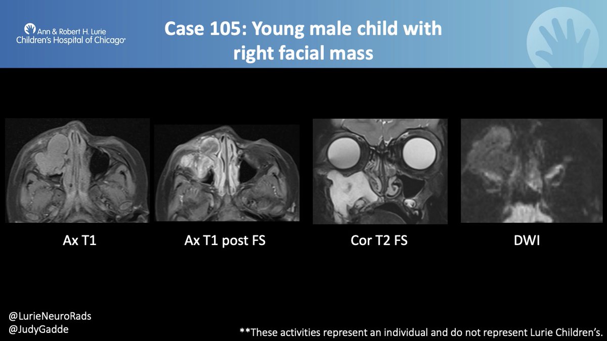 JudyGadde's tweet image. Lurie Peds Neuro Case #105
History: Young male child with right facial mass
 
*Only reply with GIFs. NO answers or spoilers.

#LuriePedsNeuro #FOAMrad #FOAMed #MedEd #NeuroRad #PediNeuroRad 
@LurieNeuroRads