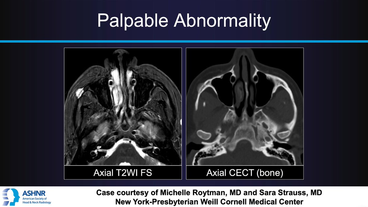 #ASHNRCOTW #214: Palpable abnormality. Dx? Thx Drs. @MichelleRoytman & @sarastrauss5 4 case! #ASHNR23 Answer w/ appropriate GIF only -- stay professional & don't spoil it! @nancyfstanford @DShatzkes @CDP_Rad @rhwiggins @nakoontz @cmtomblinson @WmOBrienDO @ESHNRSociety @TheASNR