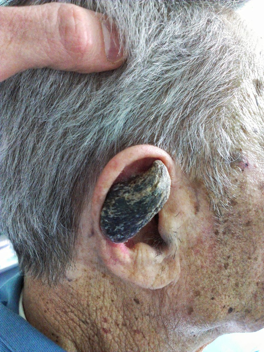 What is growing on this man's ear? 
What is the clinical name for it? 
What pathology entities cause it? 
Answers: kikoxp.com/posts/2415 
#dermpath #Pathology #dermatology #pathologists #pathTwitter #dermtwitter