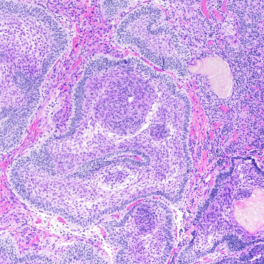 One image, one diagnosis for this sellar mass. What is it? #pathology #neuropath #PathTwitter