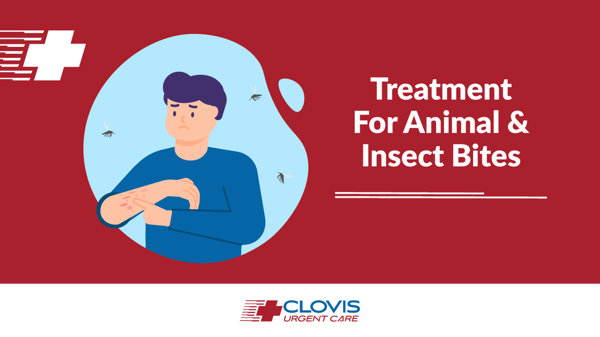 ClovisCare's tweet photo. Spring is on the horizon, which means animals and insects will be out and about soon enough. If you experience a bite or sting, visit us for fast urgent care, check-in online here: https://t.co/kmdCirvPUv
#clovisurgentcare #fresnourgentcare #spring #bugbite #animalbite #bitecare https://t.co/Qcdtszv6Mh