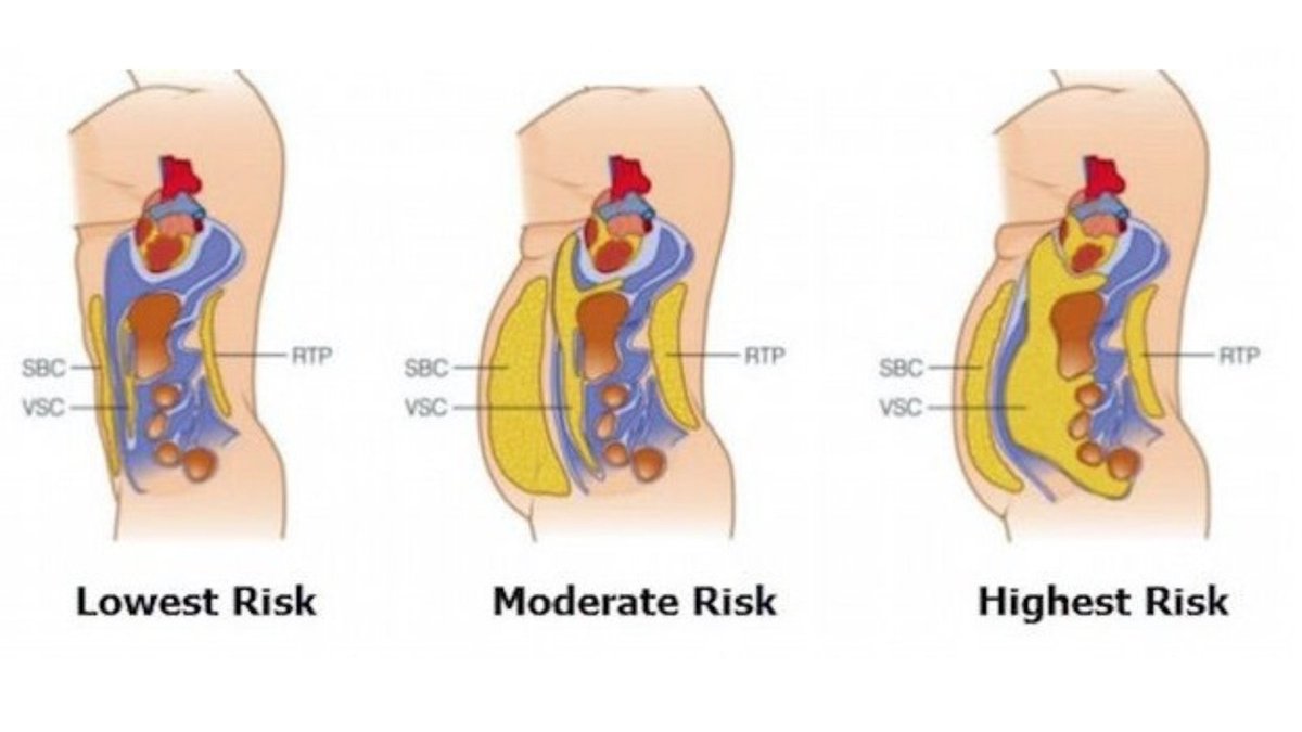As Fat Accumulates Around Your Organs You Become High risk For Heart as-fat-accumulates-around-your-organs-you-become-high-risk-for-heart