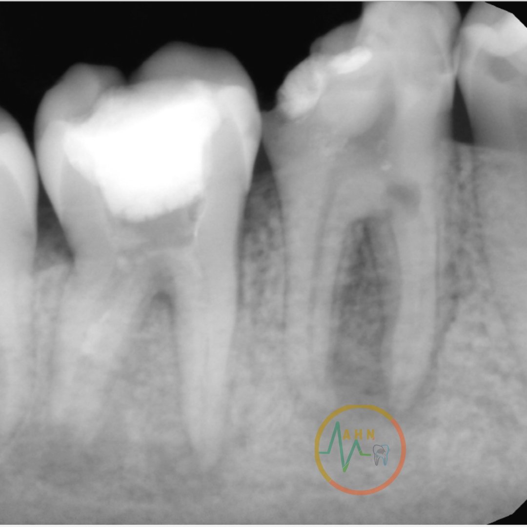 dentist_amar617's tweet photo. إعادة الحياة لسن بعلاج العصب ومتبوع بحشوة دائمة
RCT for # 46 diagosed as pulp necrosis and asymptomatic apical periodontitis
When you look at xray you will find sgins of internal recorption
Pre endodotic build of all wals to make a room for the iirigation #saveatooth 1️⃣... https://t.co/pBwZAxtTvy