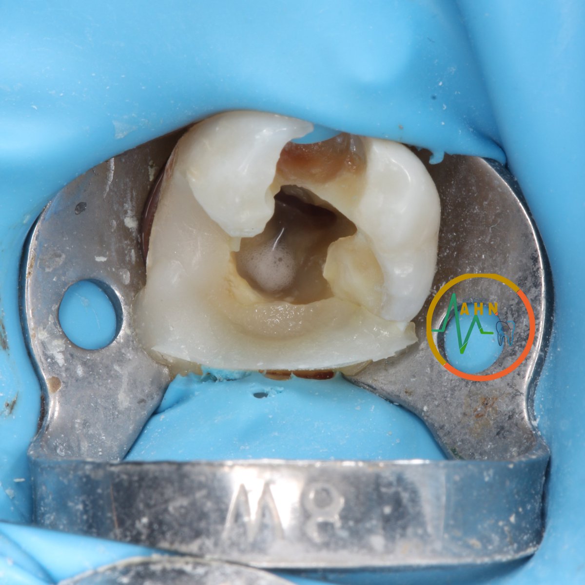 dentist_amar617's tweet photo. إعادة الحياة لسن بعلاج العصب ومتبوع بحشوة دائمة
RCT for # 46 diagosed as pulp necrosis and asymptomatic apical periodontitis
When you look at xray you will find sgins of internal recorption
Pre endodotic build of all wals to make a room for the iirigation #saveatooth 1️⃣... https://t.co/pBwZAxtTvy