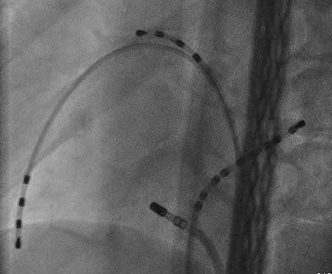 PLugenbiel's tweet photo. Interesting case of right sided accessory pathway in a patient with dextrocardia. Thanks for great support by @BiosenseWebster @JessiSchlag Note the uncommon position of RV,CS and HRA catheter in RAO and LAO view. @KathrinRahm @MauraZylla @EPeeps_Bot https://t.co/n4tJv5Ii0X