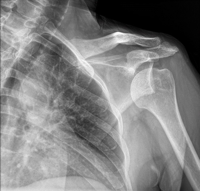 EMNews's tweet photo. There are lots of options for #shoulderreduction, but many require medication or lots of time and physical effort. @L_swish explains why her go-to is the #Aminlari technique developed by @amir_aminlari and Amy Aminlari, MD. #FOAMed https://t.co/AvTfKEsK6C https://t.co/5FPGEVcP51