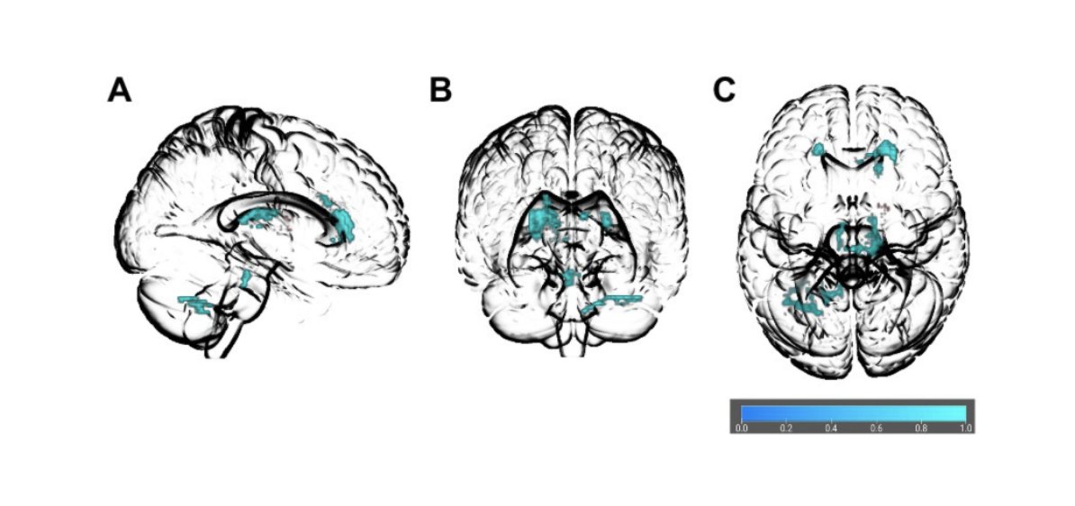 LorielleDietze's tweet photo. What are the links between obesity and brain structural connectivity? Check out our meta-analysis, from @HajekTomas lab and Dr. Joaquim Radua, "Extended and replicated white matter changes in obesity" for more information: https://t.co/V36FEwFHyK #obesity #brainhealth #research https://t.co/iStzne2zKG