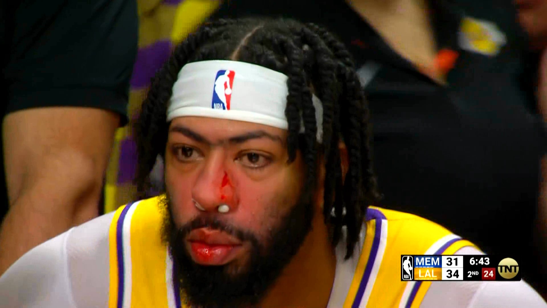 Sports Injury Central on X: "Despite taking a shot to the nose and bleeding, Anthony Davis finished last night's game with 30 points and 22 rebounds. Any concerns for lingering issues? Check