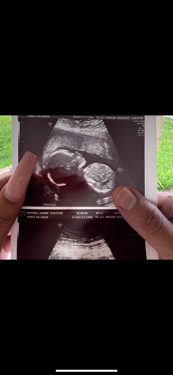 _TheLifeAsJazz's tweet photo. 20 weeks ✨

To our Baby Girl: You’re so tiny, yet so loved. There’s nothing in this world we wouldn’t do for you. Thank you for becoming the biggest blessing in mine &amp; your daddy’s life. 💗🥹 https://t.co/tb0LkVezIj