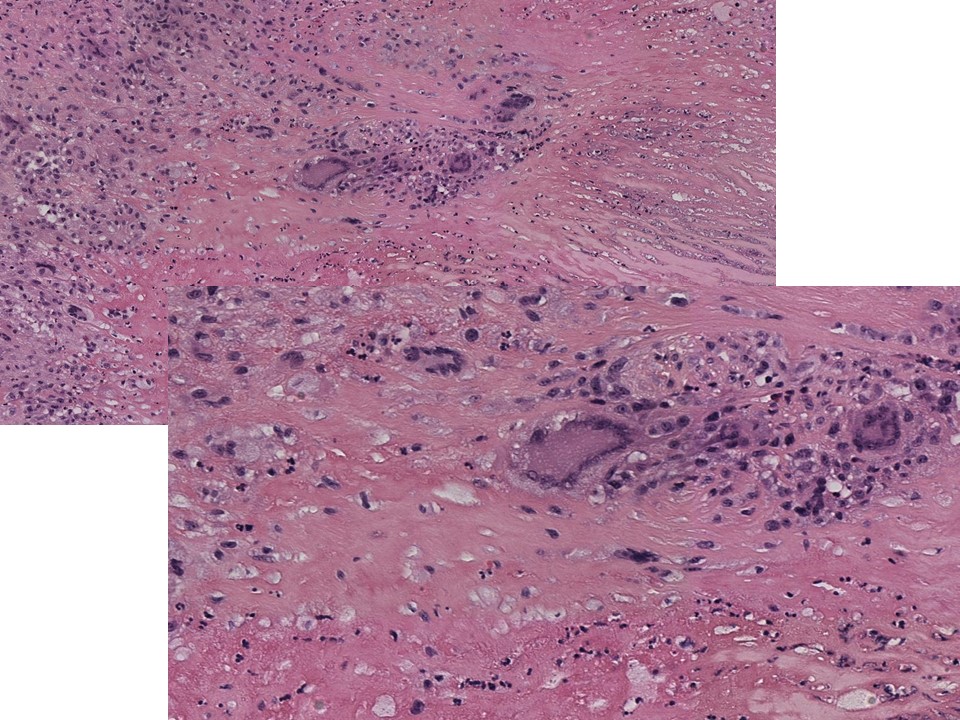 slusagar's tweet photo. here's a #heartpath🔬I'd saved:

mitral valve from patient with h/o rheumatic fever

▶️Aschoff bodies😲
▪️ Aschoff giant cells w/fibrinoid necrosis
▪️ lesion sometimes👀in acute rheumatic fever
▪️ usually found in myo/pericardium, uncommonly in endocardium/valve https://t.co/Aqp1yRt4M8