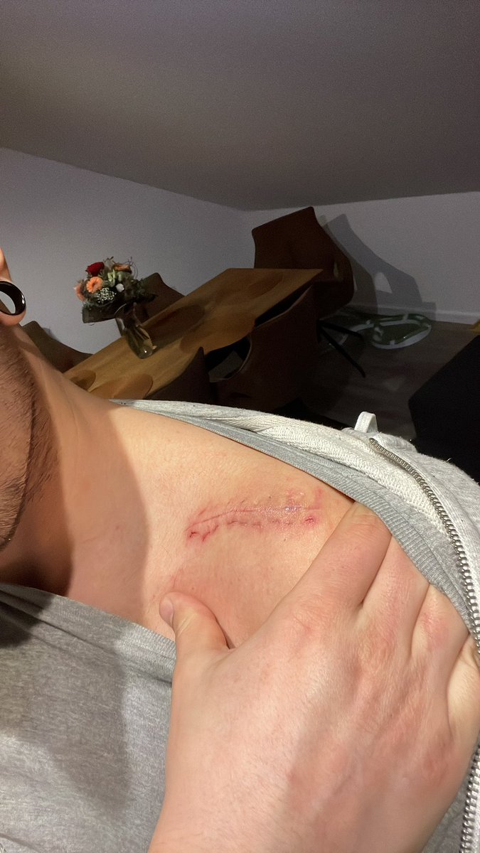 LastNightWhore's tweet photo. Aber es ist auch mit Faden echt gut verheilt. 🥴😂 https://t.co/0L2HbtME6L
