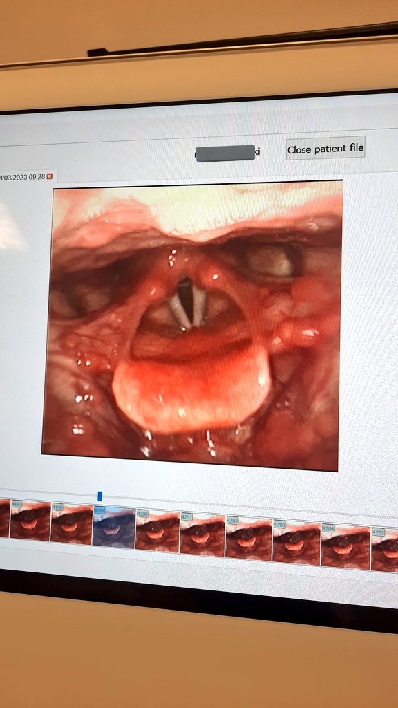 mariap_SLT's tweet image. Exciting day being scoped and learning how to scope👃 Vocal cords looking all nice😎 Definitely gave me an insight into what our patients feel when we scope them! @BHRUT_SLT