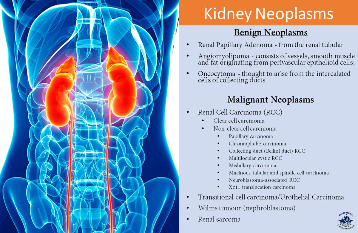 Both benign/non-cancerous & malignant/cancerous tumors can arise in the kidney. The most common #KidneyCancer is renal cell carcinoma, followed by #WilmsTumor (found mainly in children), & #UrothelialCarcinoma mainly from the kidney calyces/pelvis.

#KidneyCancerAwarenessMonth