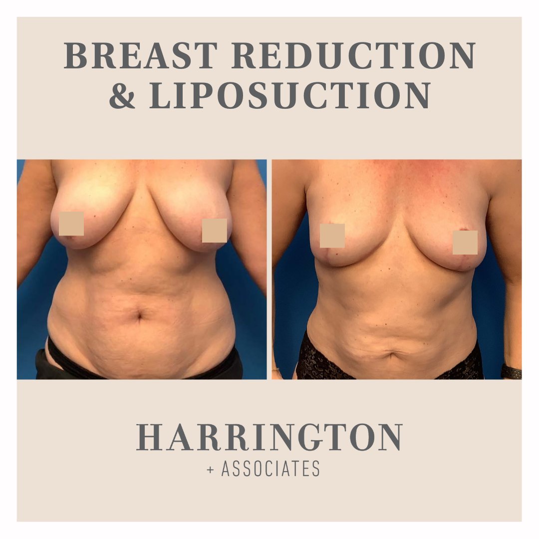 Our beautiful patient had a breast reduction with liposuction of her abdomen and flanks. She is 4 months post-op and very happy with her results!

#boardcertifiedplasticsurgeon #femaleplasticsurgeon #beforeandafter #liposuction #breastreduction #plasticsurgery #minnesota