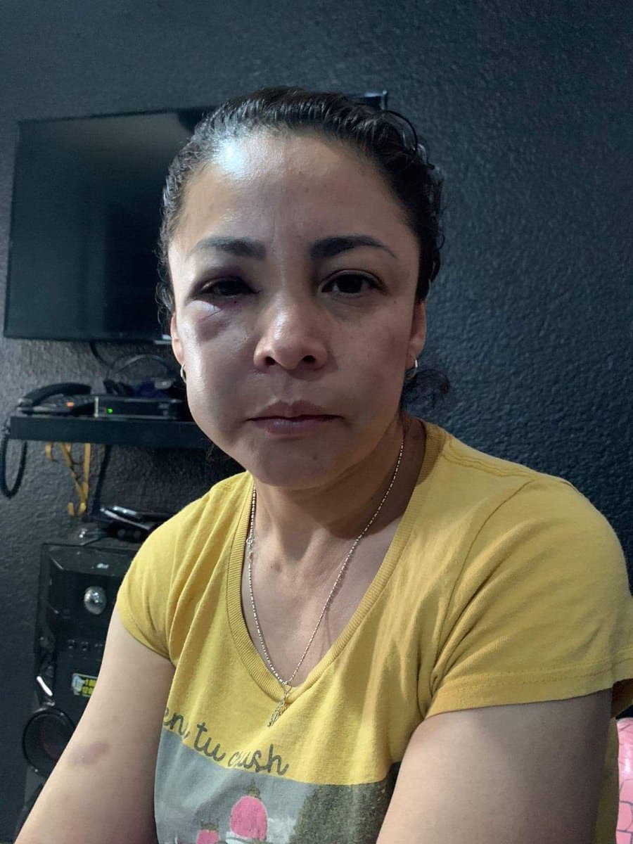 amarilloalarcon's tweet photo. En este #8M cabe recordar que una mujer fue agredida a PUÑETAZOS x los encargados del #BarBarroco en la #FeriaDelCaballo de #Texcoxo
Así ña dejaron y la @FiscaliaEdomex #FiscaliaDeTexcoco ha dejado el caso de lado y en la impunidad
Ojo fiscal José Luis Cervantes 👇🏼👇🏼 https://t.co/hnBqvcLAjM